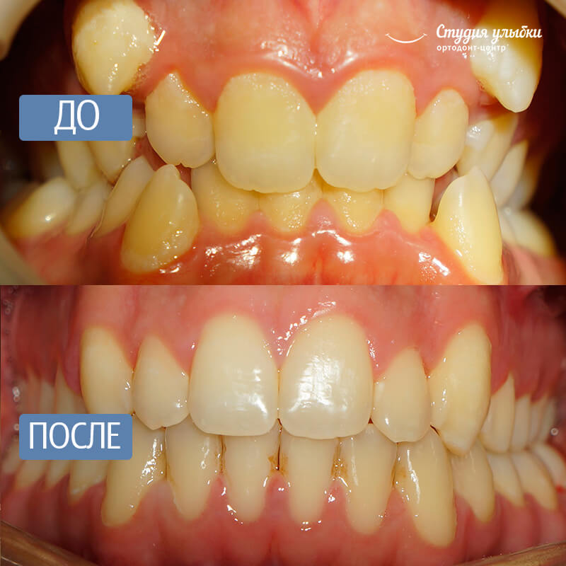 После установки брекетов стоматит