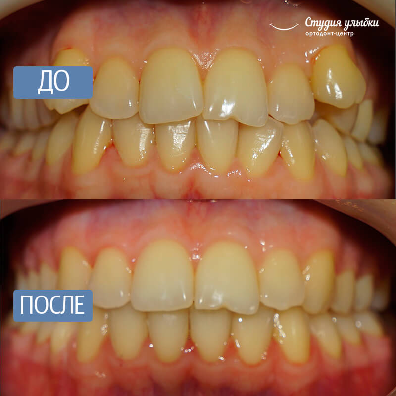 После установки брекетов стоматит