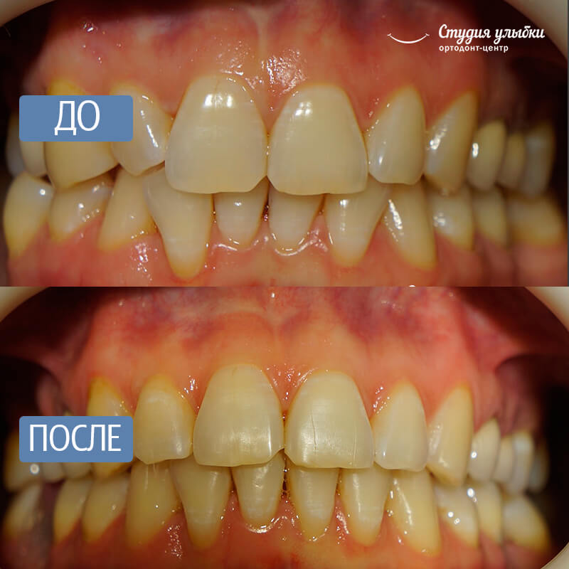 После установки брекетов стоматит