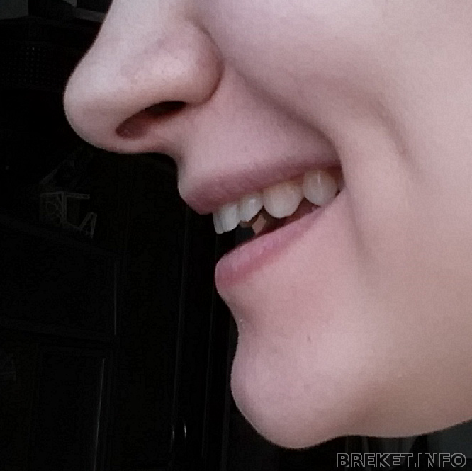Видны передние зубы. Передние зубы выпирают вперед. Выпирающая верхняя челюсть.