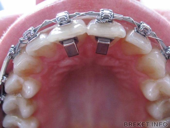 как часто меняют дуги на брекетах