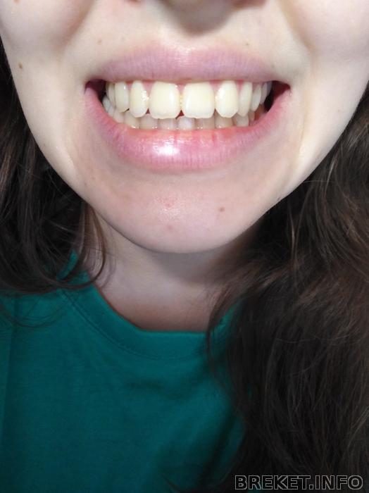после брекетов поехали зубы. после брекетов поехали зубы. исправление зубов до и после. зубы после снятия брекетов. ретейнеры после брекетов.