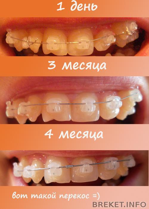 Квадратная дуга для брекетов. Припасовка дуги брекетов. Каадратная душа для брекетов. Как часто меняют дуги. Детская ортодонтия.
