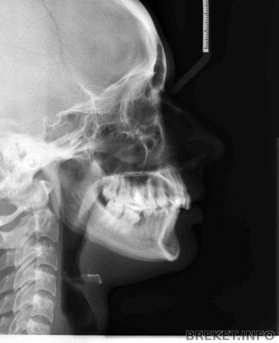 Hct тест индекс стимуляции.