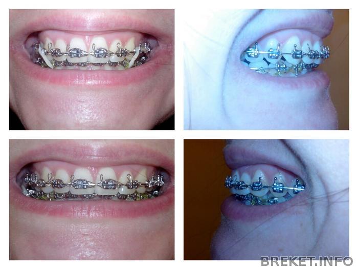 вылетела дуга из последнего брекета. стоматологическая дуга для брекетов. вылетела дуга из брекета. вылетела дуга из последнего брекета. проф гигиена с брекет системой.