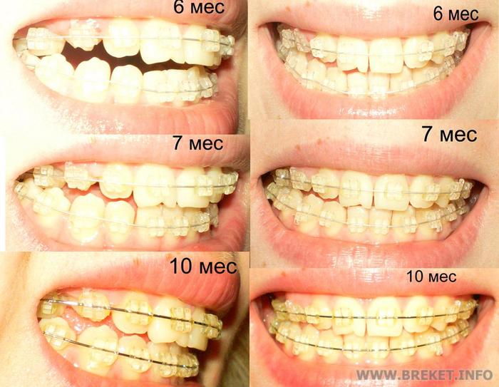Установка брекетов ижевск