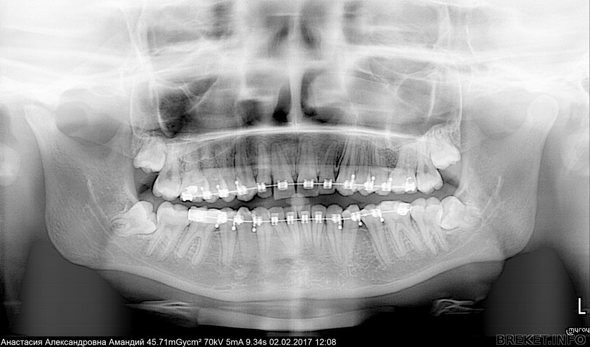 Ретинированный премоляр. Рентген снимок зубов мудрости. Зуб мудрости рентген снимок. Кривой зуб мудрости рентген. Рентген зубов мудрости.