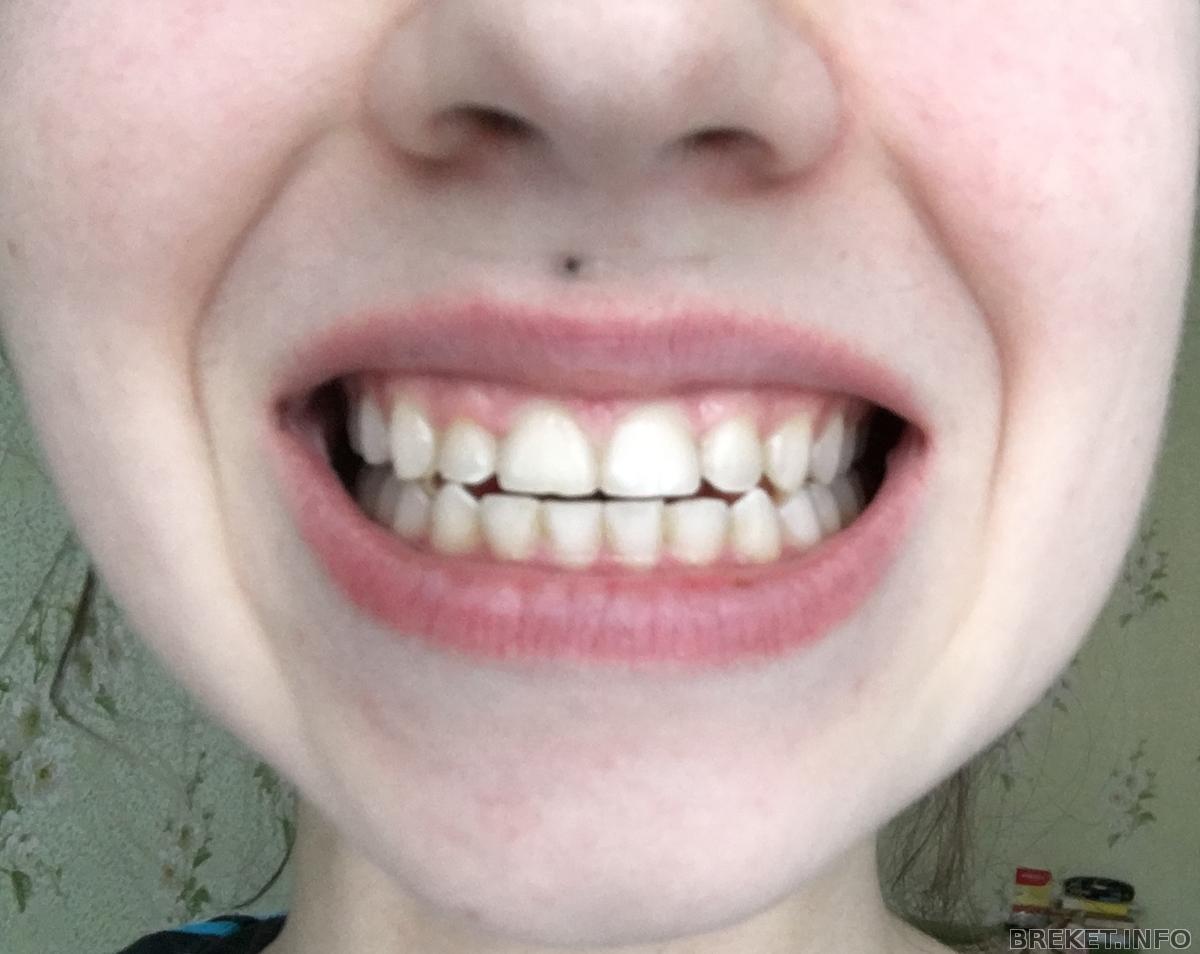Выступающие передние зубы