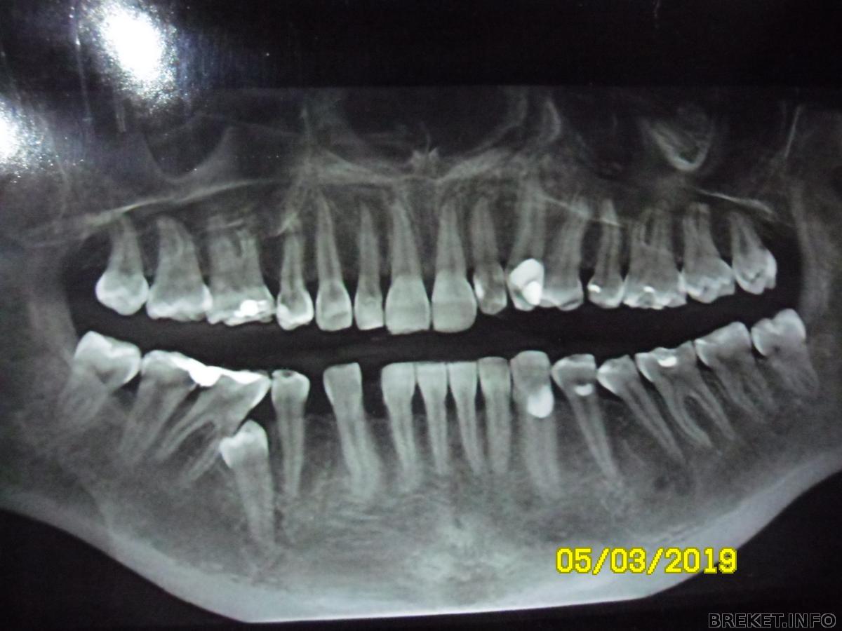 Ретенирование зуба. Ретинированный зуб снимок. Ретенированный клык рентген. Ретинированный клык ОПТГ.