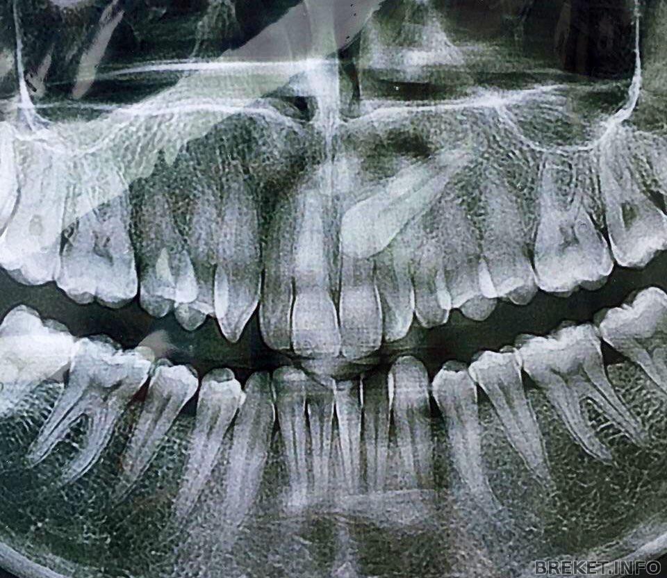 Клык фото зуба. Ретинированный клык рентген. Ретинированный клык ОПТГ. Ретинированный зуб снимок. Ретинированный зуб на верхней челюсти.
