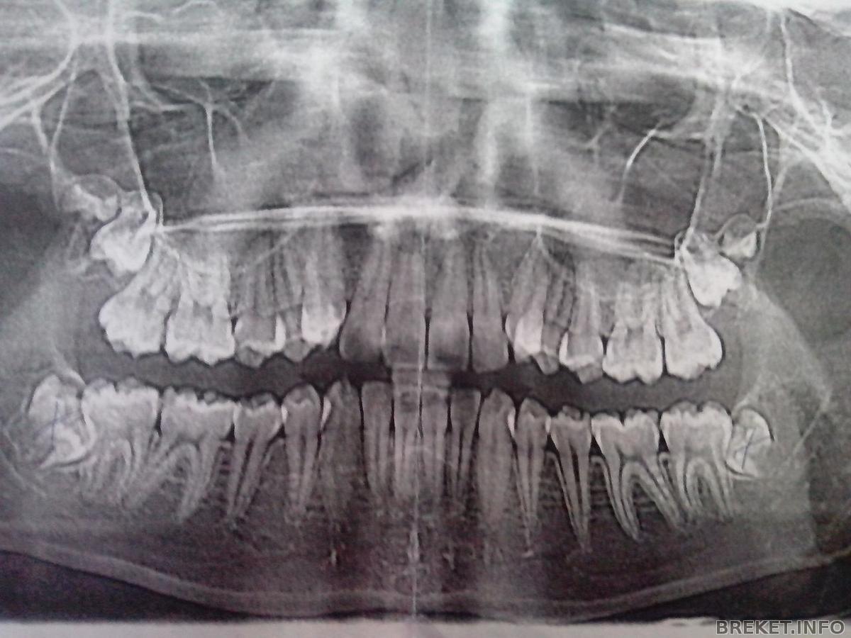 Зубы девятки. Панорамный снимок зубов 33 зуб. Ортопантомограмма зубов норма. Ортопантомограмма зубы мудрости. Воспаление десневого капюшона.